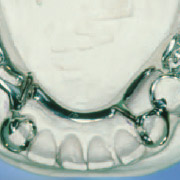 Tandarts Zevenaar - frame of plaatprothese